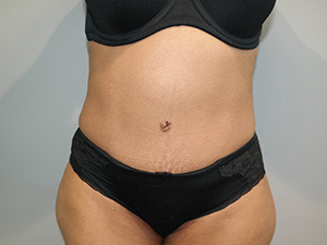 Diastasis Recti before and after - after