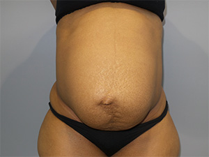 Diastasis Recti before and after - before