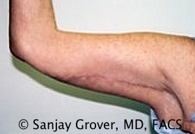 Arm Lift after — Dr. Sanjay Grover
