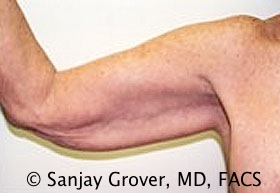 Arm Lift before — Dr. Sanjay Grover