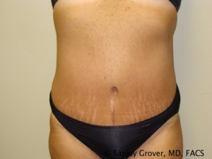 Diastasis Recti before and after - after