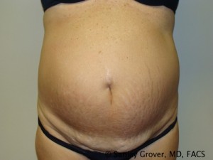 Diastasis Recti before and after - before