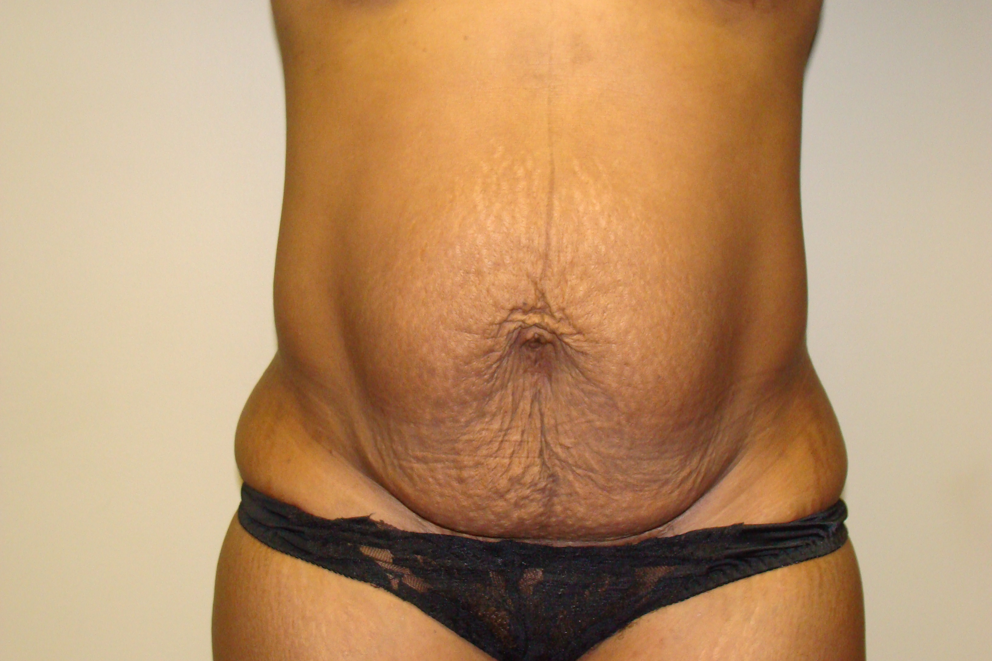 Diastasis Recti before and after - before