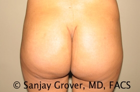 Butt Augmentation before and after - after
