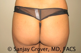 Butt Augmentation before and after - before