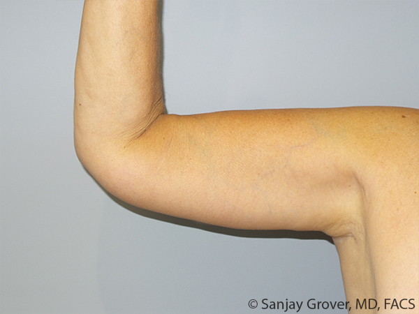 Arm Lift after — Dr. Sanjay Grover