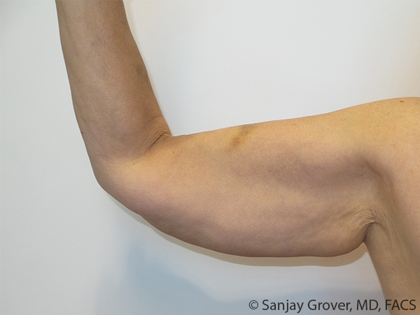 Arm Lift before — Dr. Sanjay Grover