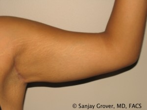 Arm Lift after — Dr. Sanjay Grover