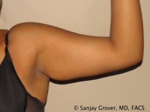 Arm Lift before — Dr. Sanjay Grover