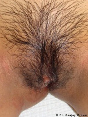 Labiaplasty after — Dr. Sanjay Grover