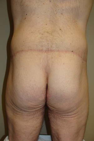 Belt Lipectomy before and after - before