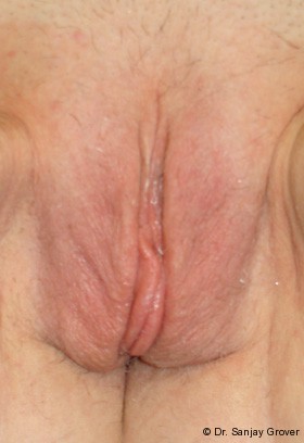 Labiaplasty before — Dr. Sanjay Grover