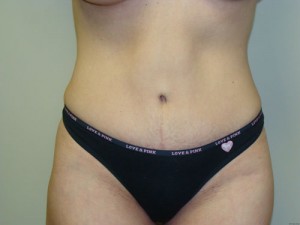 Diastasis Recti before and after - after