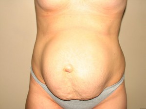 Diastasis Recti before and after - before