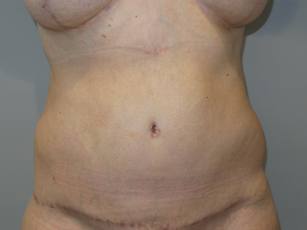 Belt Lipectomy before and after - after