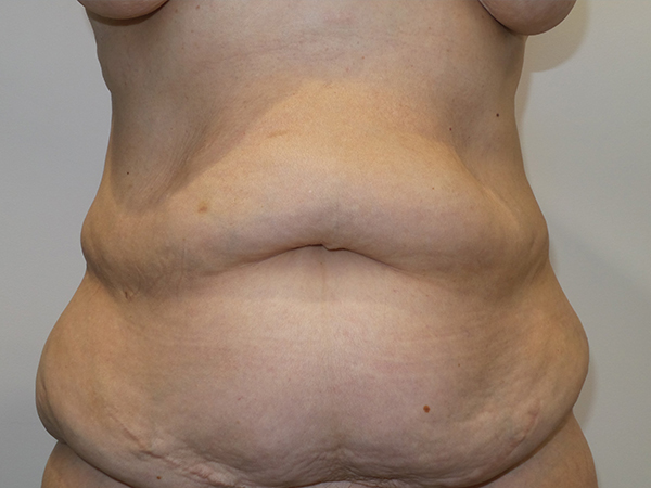 Belt Lipectomy before and after - before