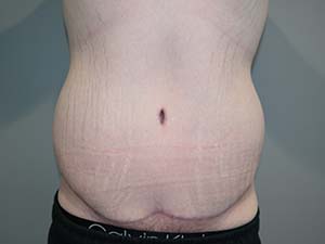 Belt Lipectomy before and after - after