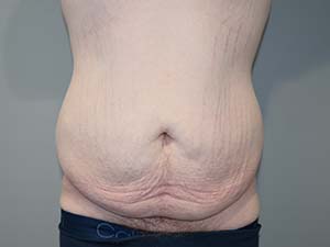 Belt Lipectomy before and after - before