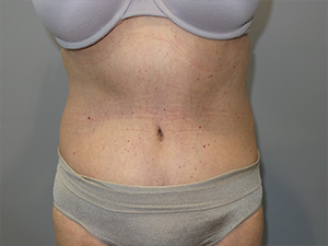 Belt Lipectomy before and after - after