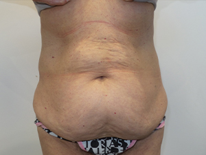 Belt Lipectomy before and after - before