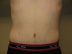 Belt Lipectomy before and after - after