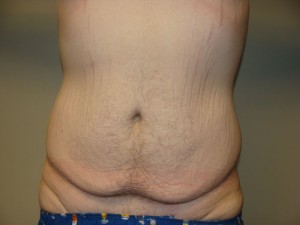 Belt Lipectomy before and after - before