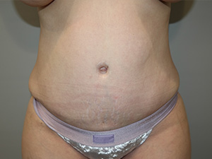 Diastasis Recti before and after - after