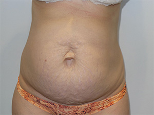 Diastasis Recti before and after - before