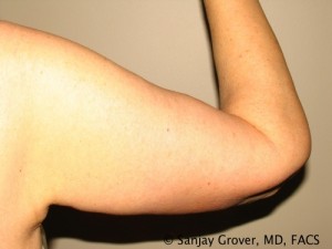 Arm Lift after — Dr. Sanjay Grover