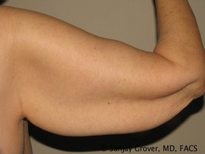 Arm Lift before — Dr. Sanjay Grover