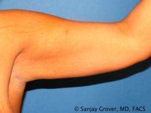 Arm Lift after — Dr. Sanjay Grover