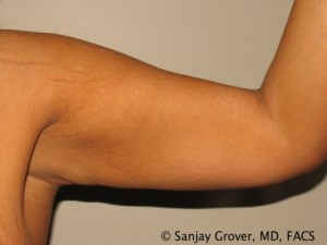 Arm Lift before — Dr. Sanjay Grover