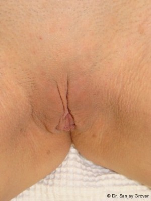 Labiaplasty after — Dr. Sanjay Grover