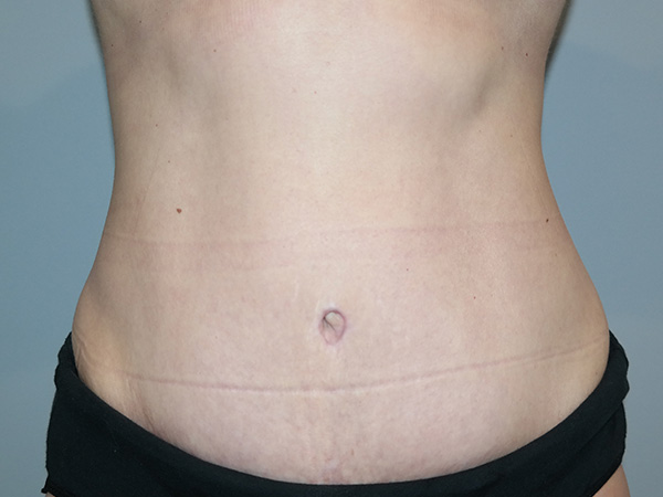 Diastasis Recti before and after - after
