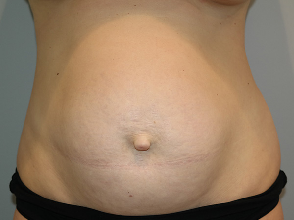 Diastasis Recti before and after - before