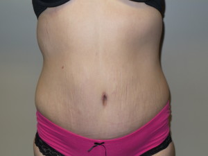 Belt Lipectomy before and after - after