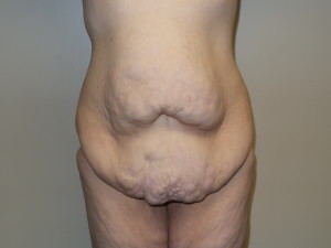 Belt Lipectomy before and after - before