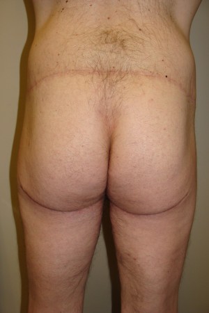 Thigh Lift before and after - after