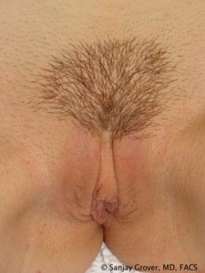 Labiaplasty after — Dr. Sanjay Grover