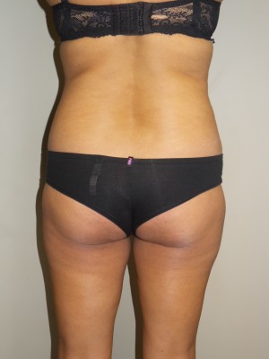 Butt Augmentation before and after - before