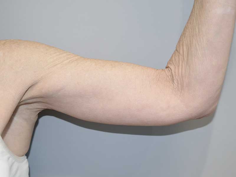 Arm Lift after — Dr. Sanjay Grover