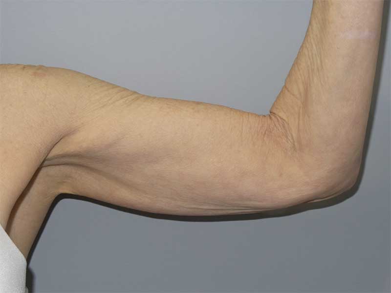 Arm Lift before — Dr. Sanjay Grover