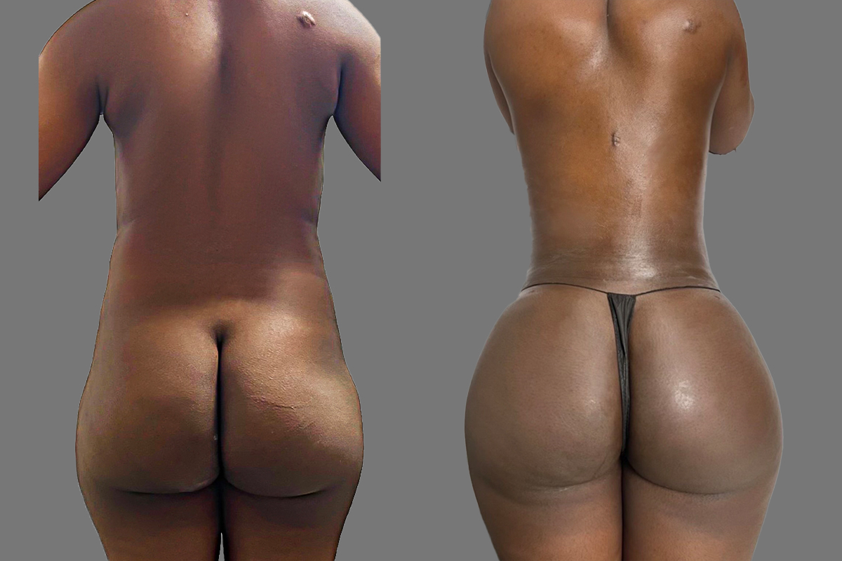 BBL before and after - after
