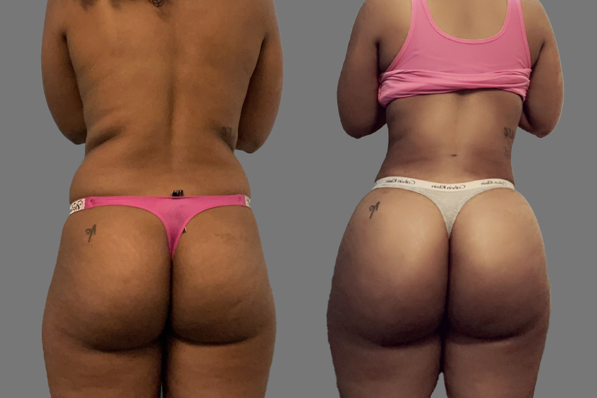 BBL before and after - before
