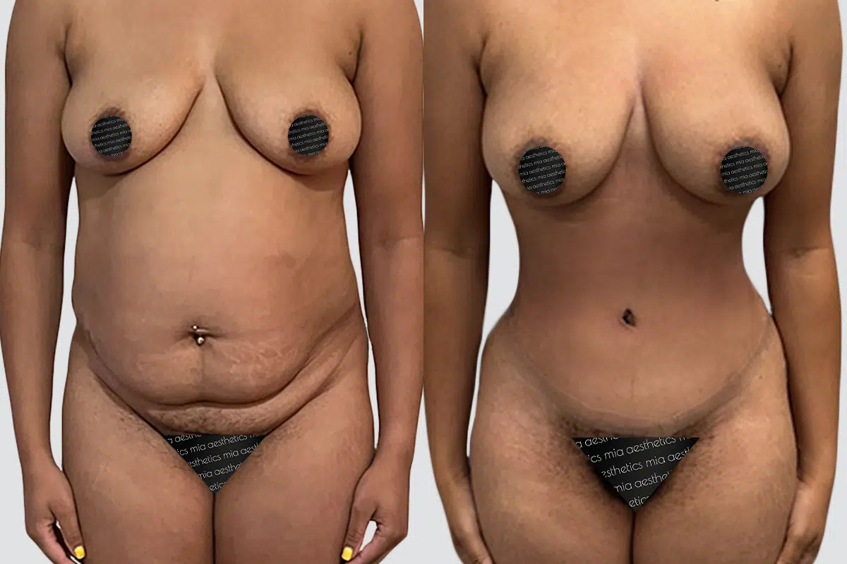 Tummy Tuck before and after - after