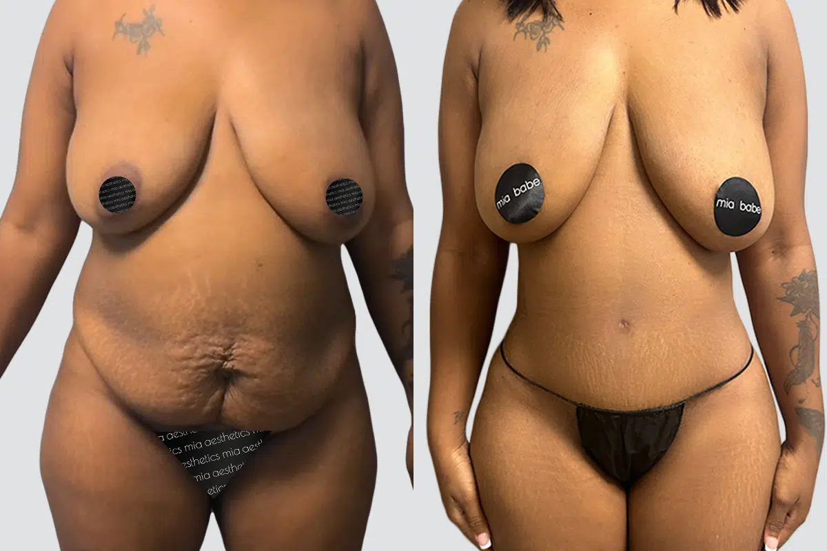 Tummy Tuck before and after - before