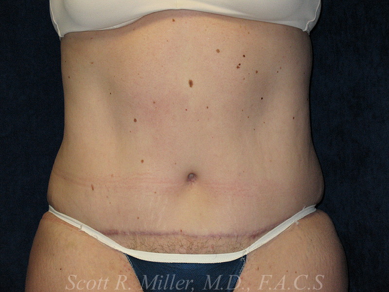 Tummy Tuck before and after - after
