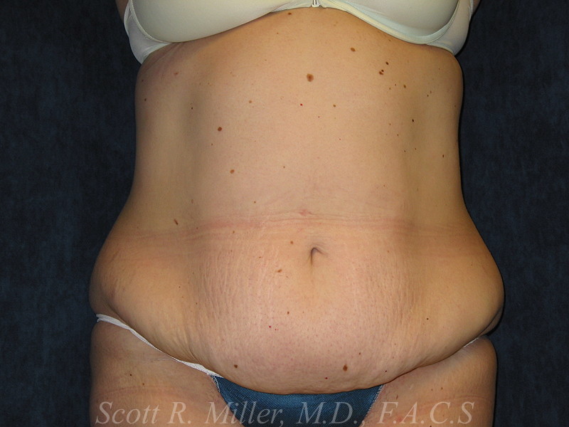 Tummy Tuck before and after - before
