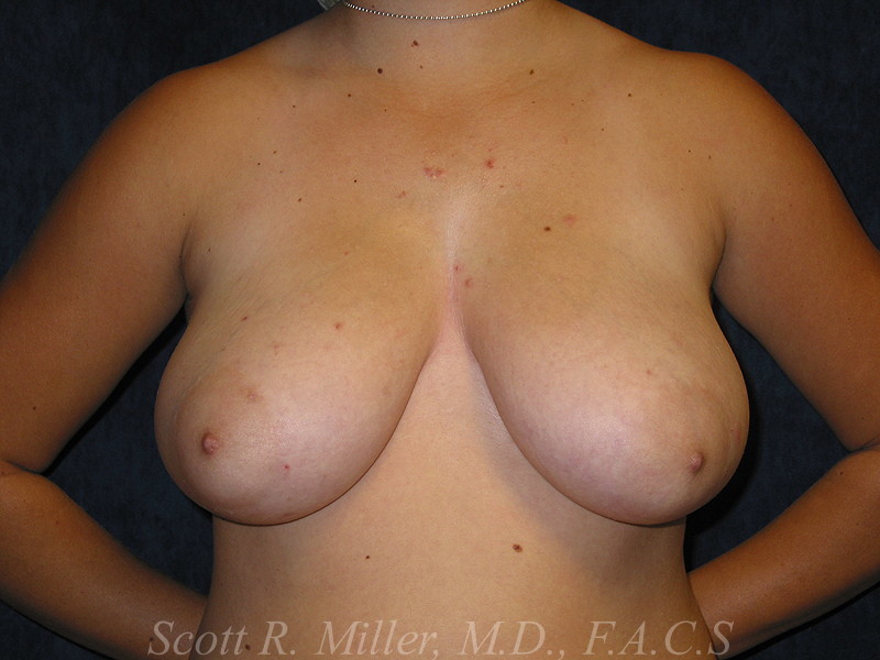 Breast Reduction before and after - before