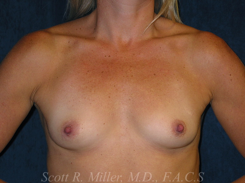 Breast Augmentation before and after - before